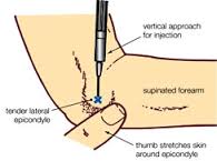 tennis elbow injection, تزریق استروئید در آرنج تنیس بازان, تزریق در آرنج تنیس بازان